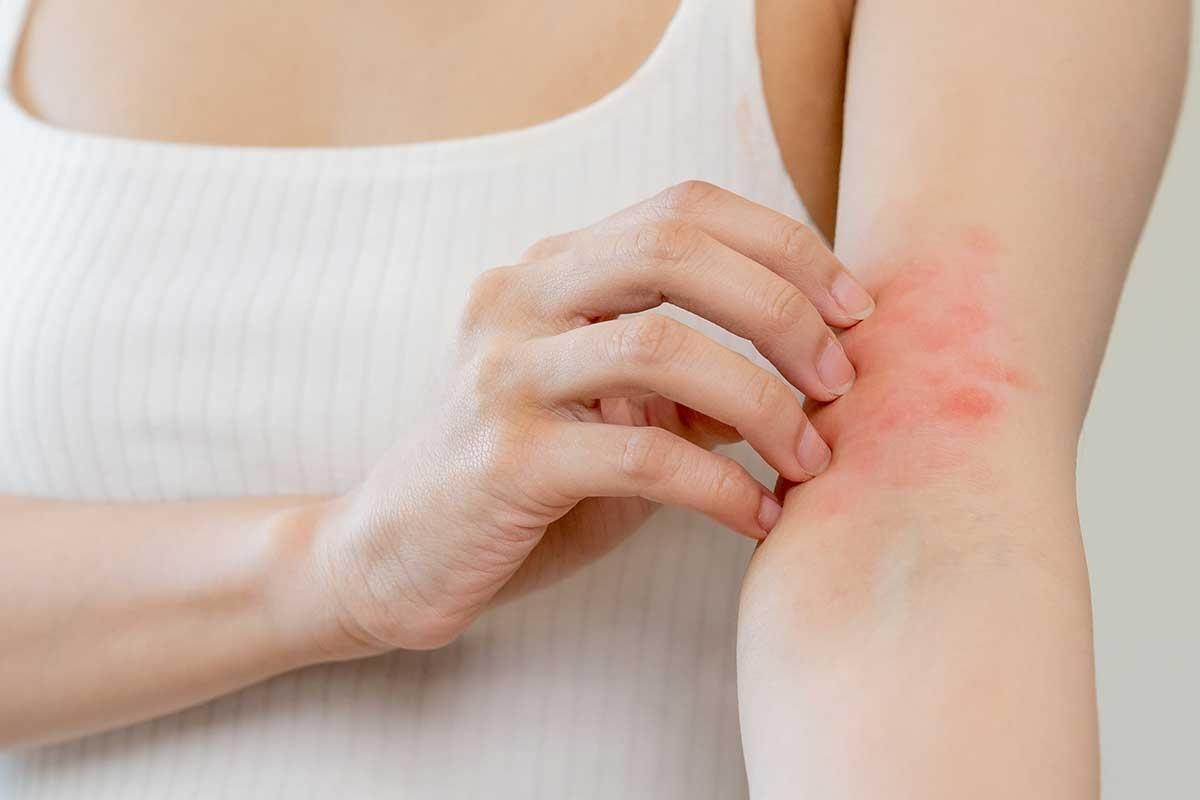 Les Allergies : Causes, Symptômes et Traitements