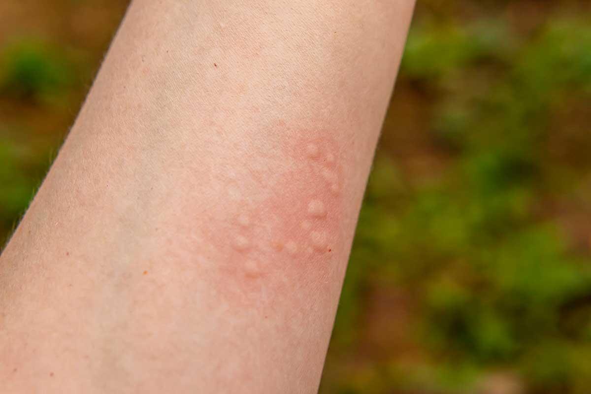 Tout Savoir sur l’Urticaire : Symptômes, Causes et Traitements