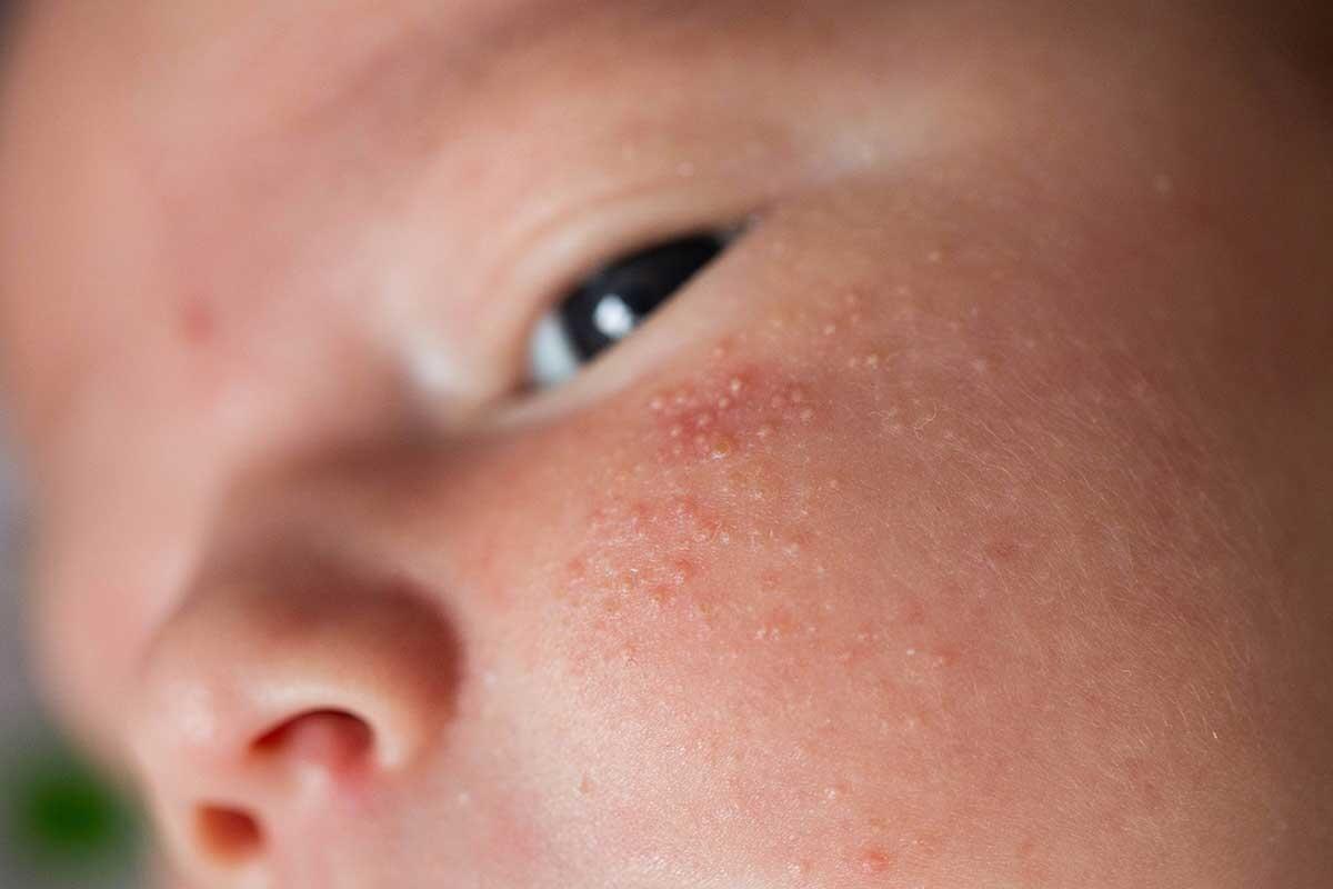 Brotoeja : Causes, Symptômes et Traitements Efficaces