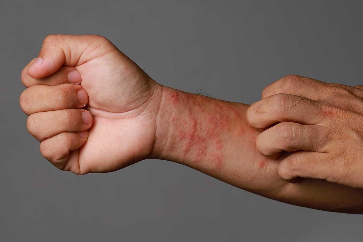 Eczéma : Symptômes, Causes et Traitements Efficaces