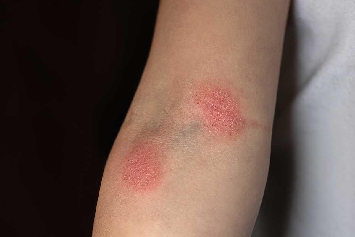 Mycoses : Causes, Types, Symptômes et Traitements