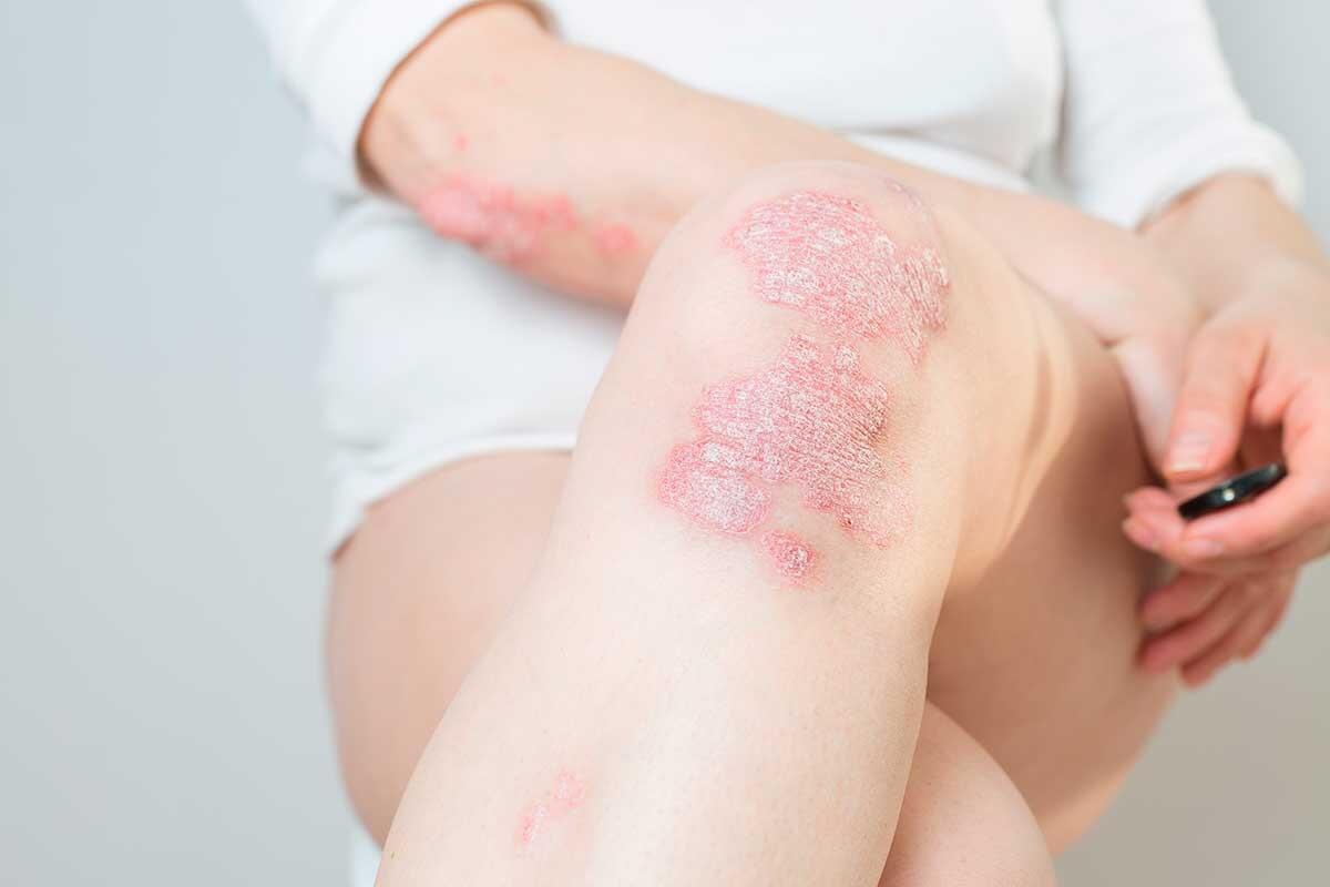 Psoriasis : Causes, Symptômes et Traitements Efficaces