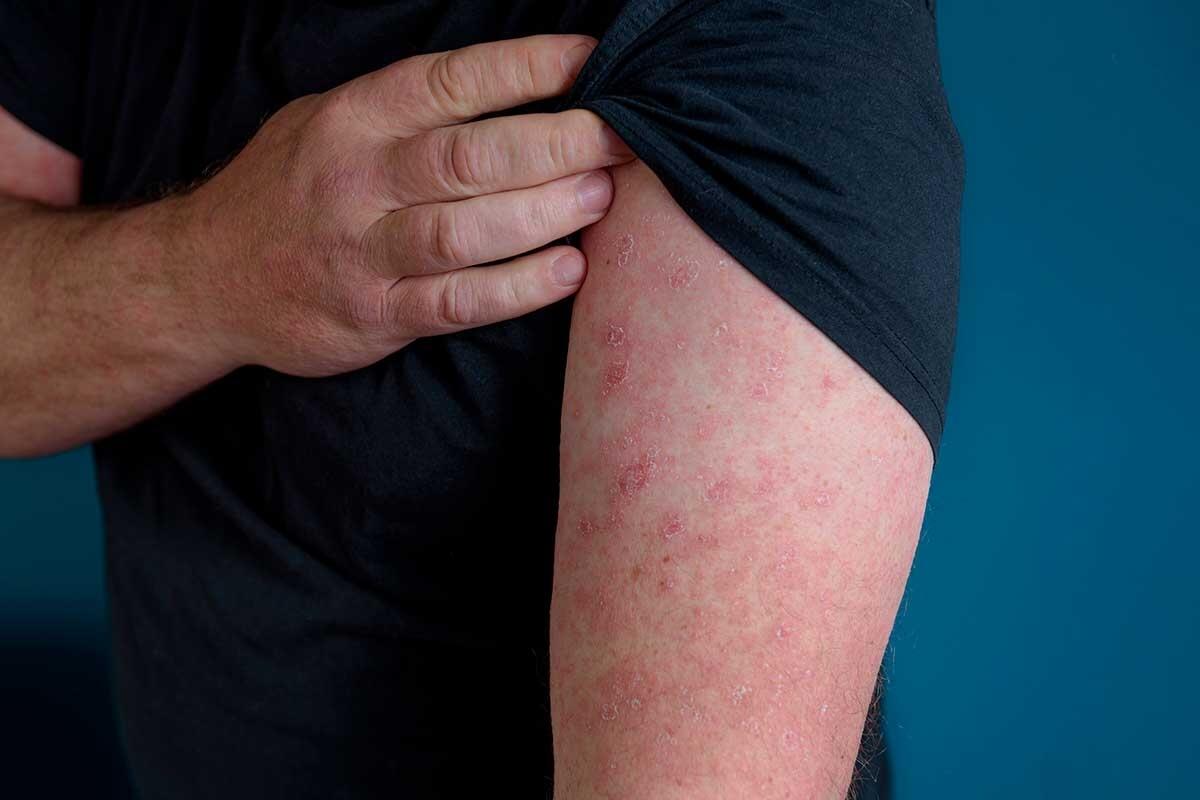 Érysipèle : Symptômes, Causes et Traitements Efficaces