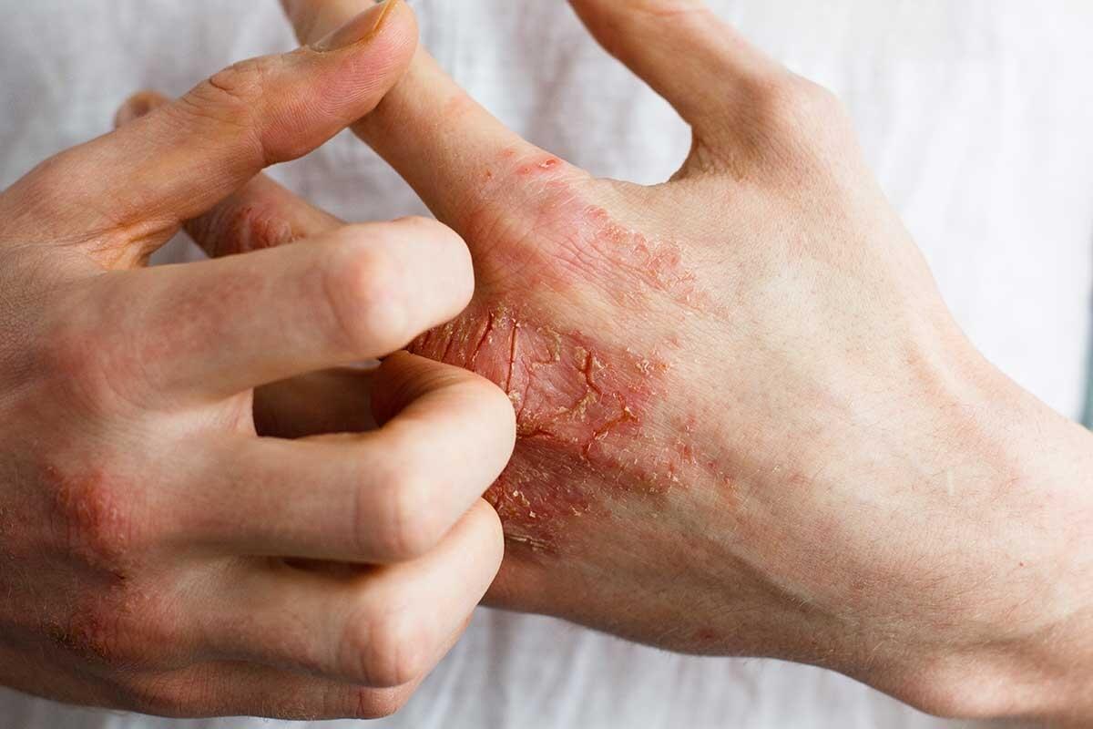 Dermatites : Comprendre la Dermatite de Contact et la Dermatite Atopique